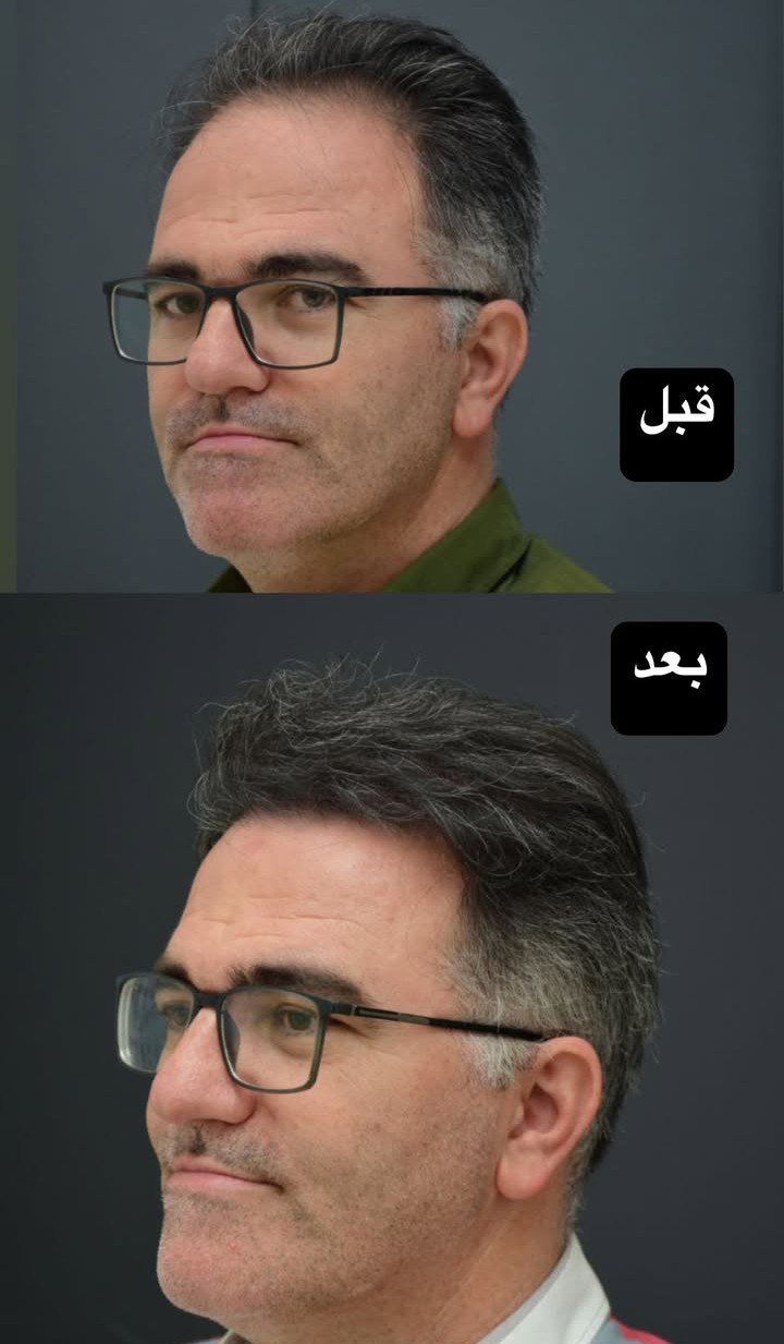 قبل و بعد کاشت مو با خط رویش طبیعی و استاندارد 4